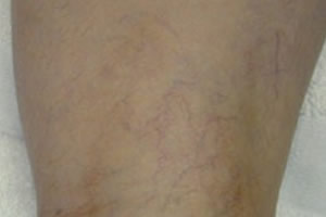 vein removal legs after white plains greenwich